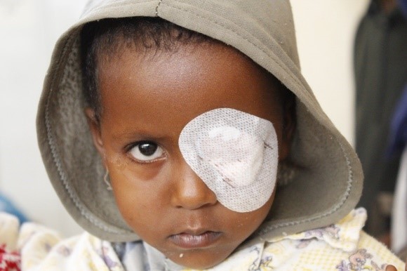 Eye Operations Campaign in Mali - مخيمات العيون في مالي