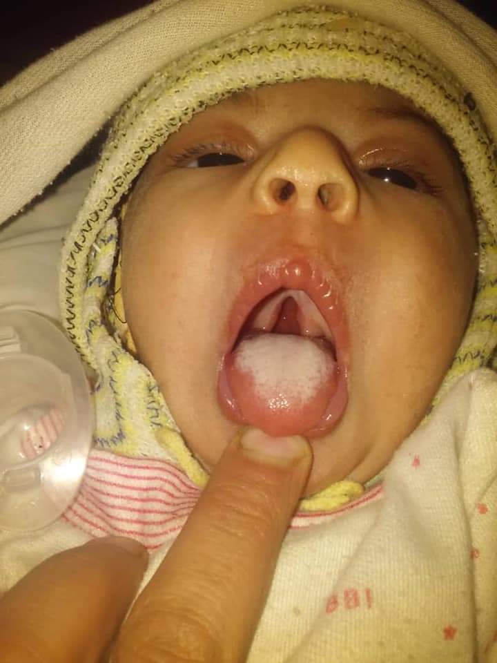 Urgent surgery for a Yemeni child who suffers from a congenital deformity