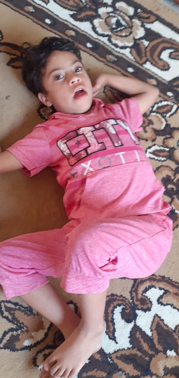 Special care for a Child with Down Syndrome