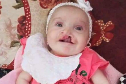 عملية قلب مفتوح لطفلة مهجرة